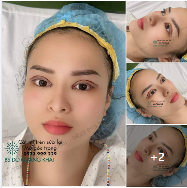 CẮT MÍ TRÊN SỬA LẠI + MỞ GÓC MẮT TRONG