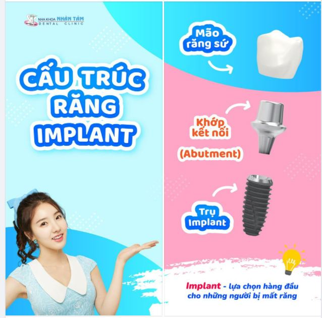 CẤU TRÚC RĂNG IMPLANT GỒM NHỮNG GÌ