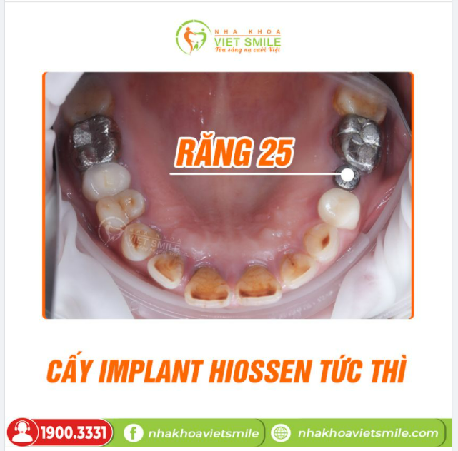 CẤY GHÉP IMPLANT TỨC THÌ NGAY SAU KHI NHỔ RĂNG 25