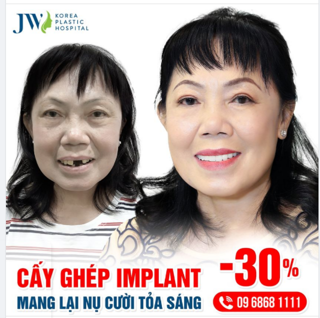 CẤY GHÉP IMPLANT - XÓA TAN NỖI SỢ MẤT RĂNG, TRẢ LẠI NỤ CƯỜI ĐẸP NHƯ MƠ
