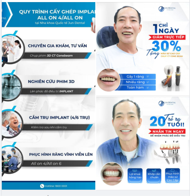 CẤY RĂNG CHỈ 1 NGÀY  I.M PLANT - Hơn đứt Phương pháp Truyền thống.