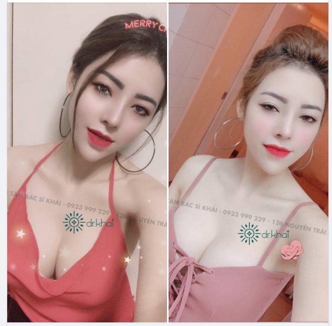 Chào ngày mới tươi xinh với khách hàng thực tế làm đẹp với SIÊU COMBO tại BÁC SĨ KHẢI sau 3 năm.