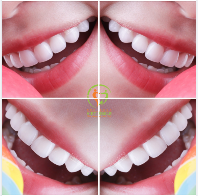 Chỉ 2 lần hẹn - Thay áo mới cho nụ cười- Độ thần thái xinh sang chảnh như khách hàng tại VIET SMILE
