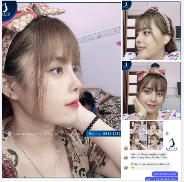 Chiếc mũi 10 NGÀY không sưng, không bầm, ai gặp cũng khen, hỏi địa chỉ xin làm...