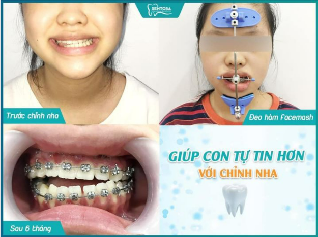 CHỈNH NHA CHO CON ĐÚNG THỜI ĐIỂM QUAN TRỌNG HAY RẤT QUAN TRỌNG