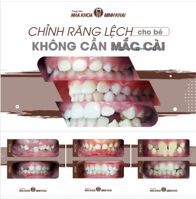 CHỈNH RĂNG LỆCH CHO BÉ KHÔNG CẦN MẮC CÀI