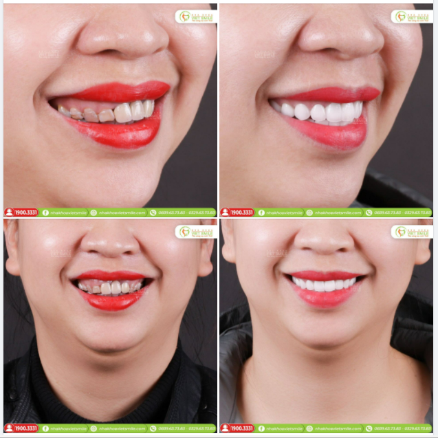 CHỌN RĂNG TOÀN SỨ CAO CẤP - CHỌN NỤ CƯỜI KHỎE ĐẸP