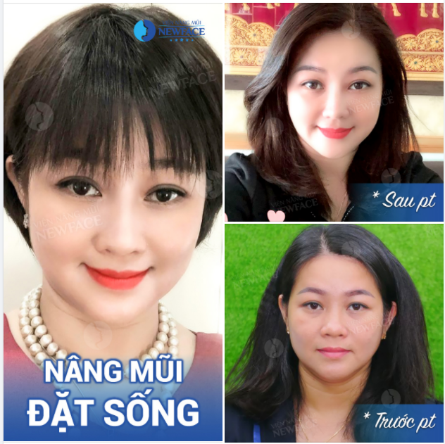 Chuẩn thần thái “quý bà” sau nâng mũi đặt sống