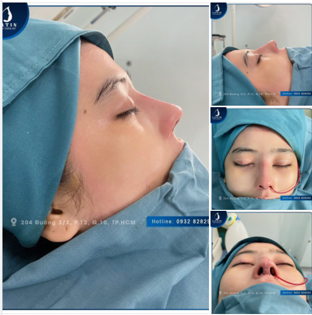 CÔ GÁI NÂNG MŨI TÁI CẤU TRÚC - KẾT HỢP BỌC MEGADERM