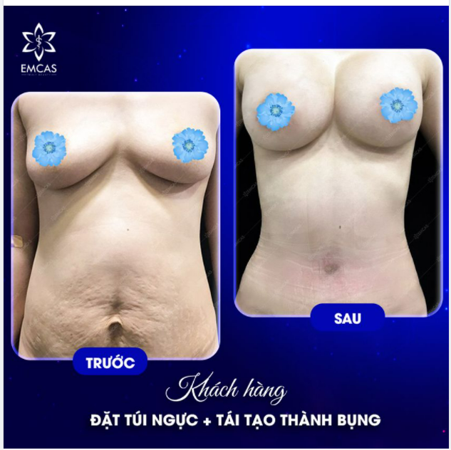 COMBO ĐẶT TÚI NÂNG NGỰC + TÁI TẠO THÀNH BỤNG