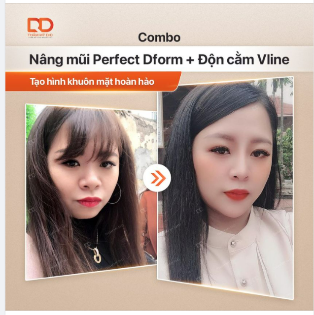 Combo Nâng mũi Perfect Dform + Độn cằm Vline = Tạo hình gương mặt hoàn hảo.
