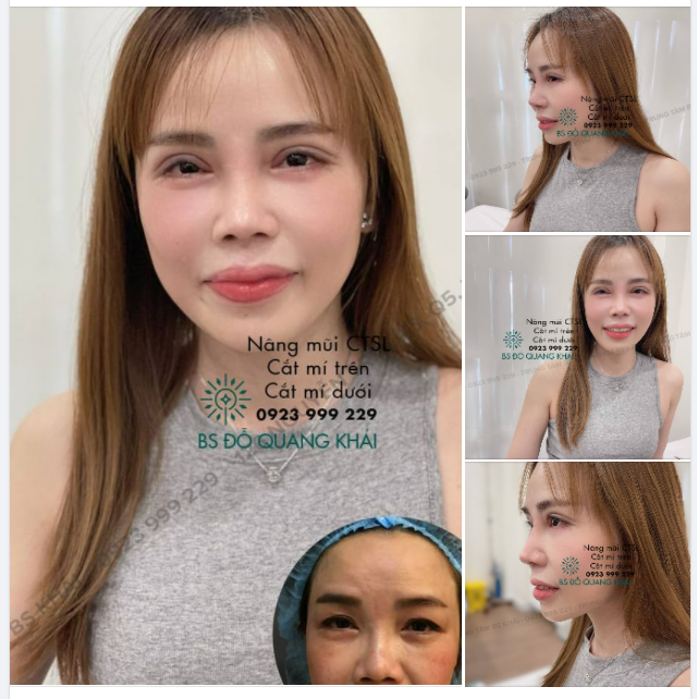 COMBO NÂNG TẦM NHAN SẮC NÂNG MŨI CẤU TRÚC kết hợp CẮT MÍ TRÊN, DƯỚI