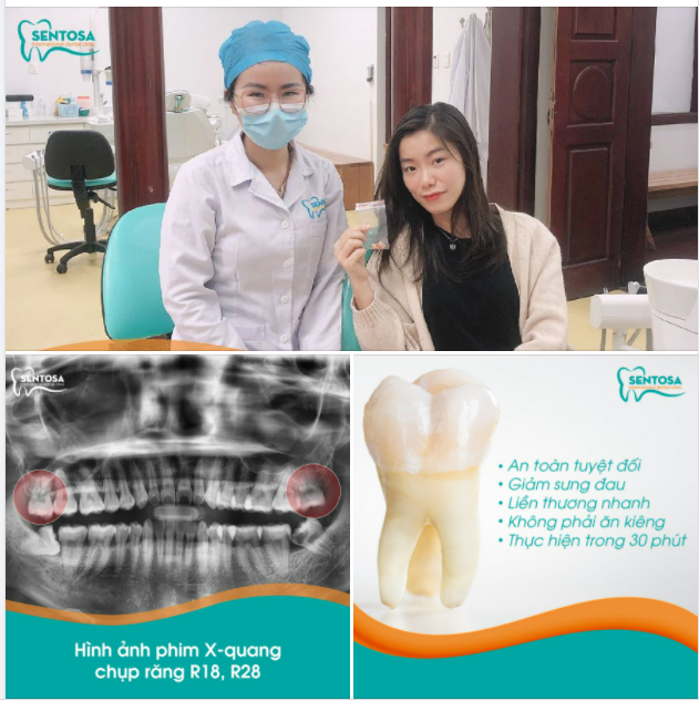 CÔNG NGHỆ NHỔ RĂNG THẦN KỲ - NHỔ NHƯ KHÔNG NHỔ