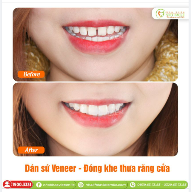 DÁN SỨ VENEER - ĐÓNG KHE THƯA RĂNG CỬA