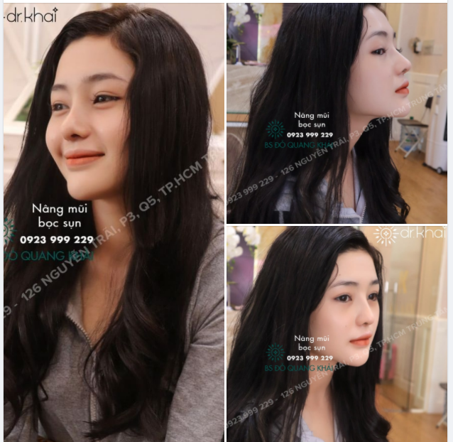 DÁNG MŨI BỌC SỤN sau 1 tháng phải gọi là ĐẸP ĐIÊN ĐẢO BAO CHÀNG