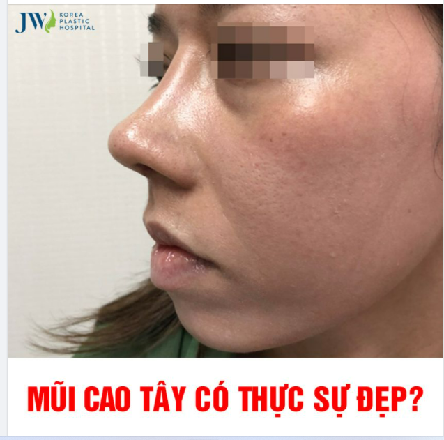DÁNG MŨI CAO TÂY CÓ THỰC SỰ PHÙ HỢP VỚI NGƯỜI CHÂU Á