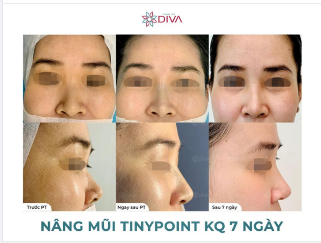 DÁNG MŨI CAO THANH THOÁT SAU 7 NGÀY THẨM MỸ