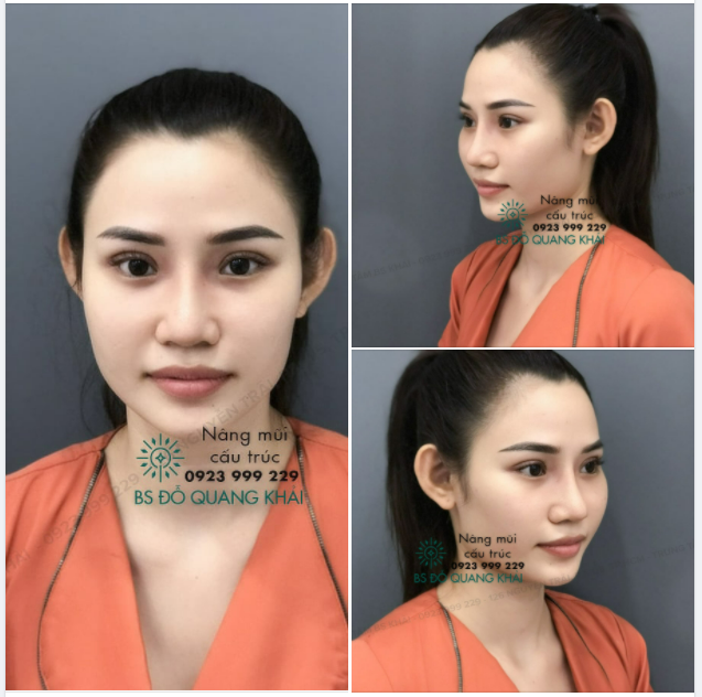 DÁNG MŨI CẤU TRÚC 10 NGÀY TUỔI