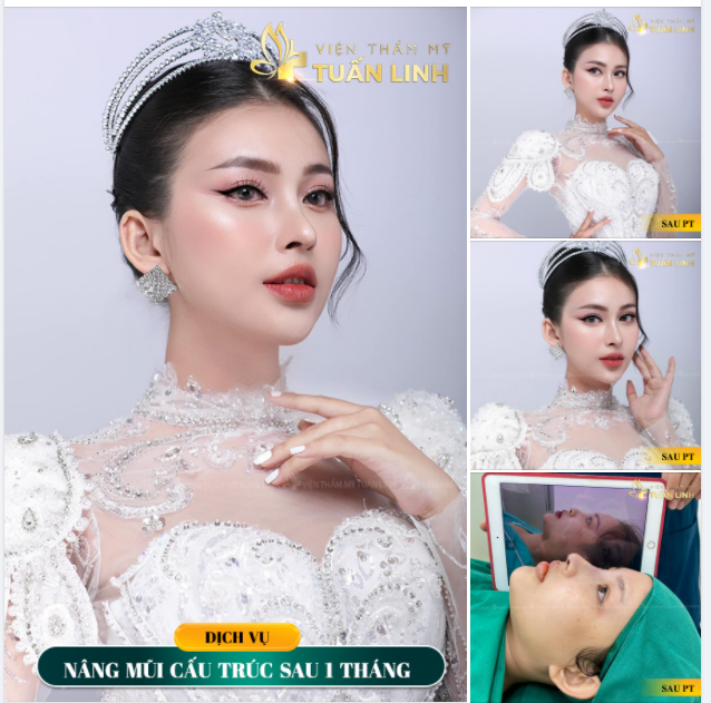 DÁNG MŨI SAU 1 THÁNG NÂNG CẤU TRÚC TẠI TUẤN LINH.