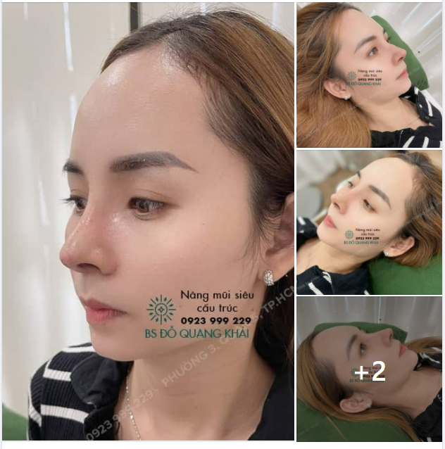 DÁNG MŨI SIÊU CẤU TRÚC LIÊN TỤC ĐƯỢC CHỊ EM CẬP NHẬT
