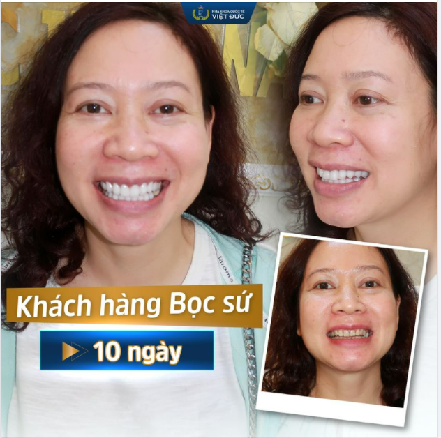 ĐÁNH BAY Ố VÀNG, SỞ HỮU NỤ CƯỜI ĐẸP TỰ NHIÊN