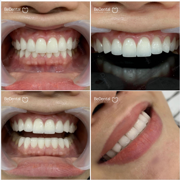 Đây là hình ảnh khách nhà Be tái khám sau 3 năm thẩm mỹ răng sứ