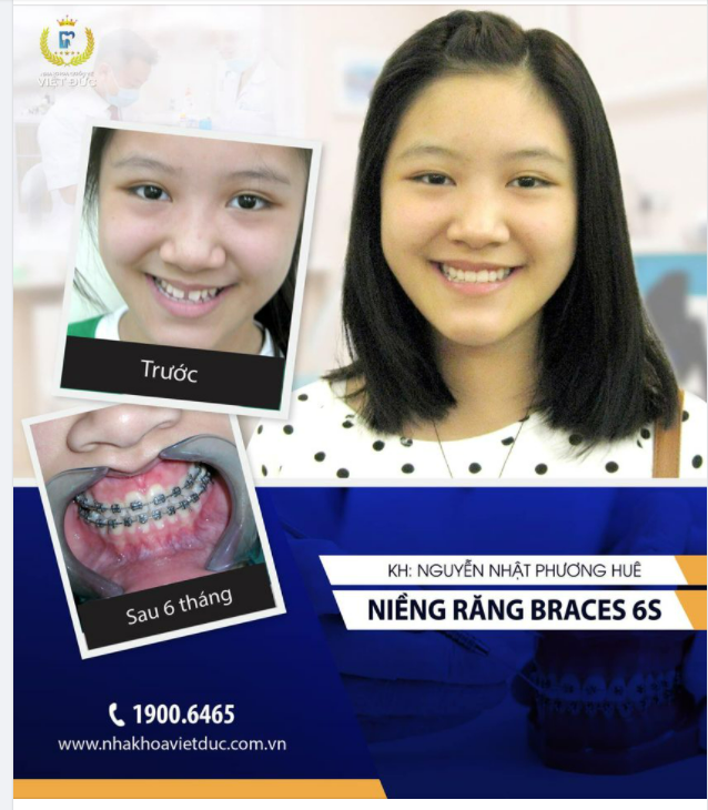 DẬY THÌ THÀNH CÔNG NHỜ NIỀNG RĂNG