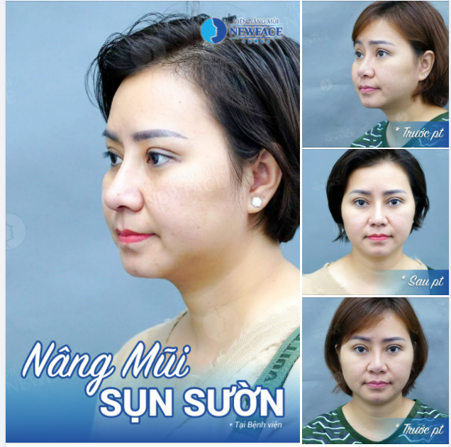 Để “Say no” với biến chứng Không cách gì khác ngoài sụn sườn !!