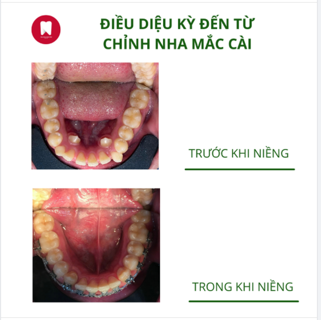 ĐIỀU DIỆU KỲ ĐẾN TỪ CHỈNH NHA MẮC CÀI - KẾT QUẢ TRÊN CẢ TUYỆT VỜI