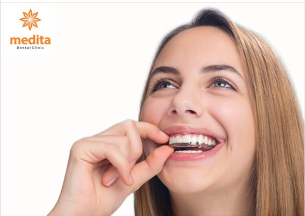 ĐIỀU GÌ XẢY RA KHI BẠN ĐEO NIỀNG INVISALIGN