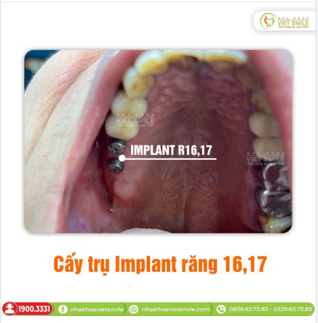 ĐIỀU GÌ XẢY RA KHI MẤ.T CẢ 2 RĂNG HÀM 6,7