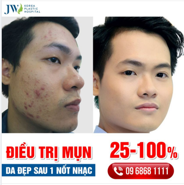 ĐIỀU TRỊ MỤN LASER – DA ĐẸP KHÔNG KHÓ, ĐỂ JW LO!