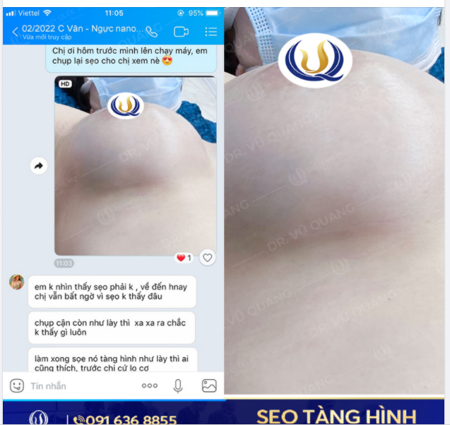 Đỉnh cao Nâng NGỰC ​​​​​​​ không để lại sẹo