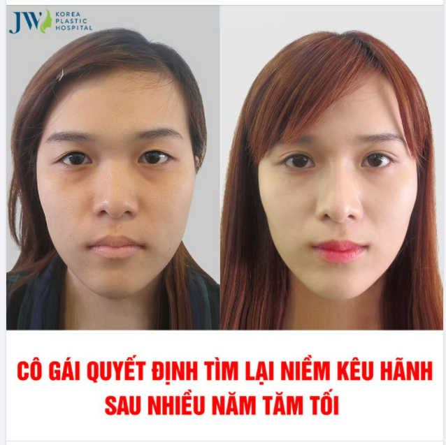 ĐÔI MẮT HÍP ĐÁNH MẤT NIỀM KIỀU HÃNH CỦA CÔ GÁI TRẺ TUỔI 18…