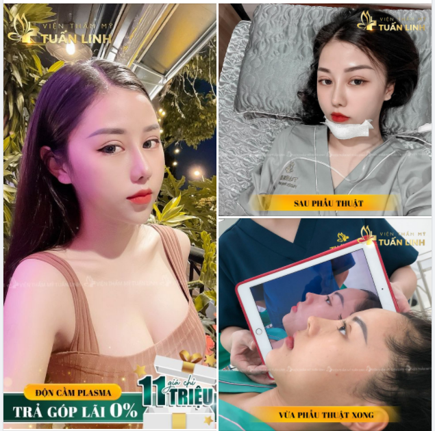 Độn cằm tại Tuấn Linh với công nghệ Plasma hiện đại
