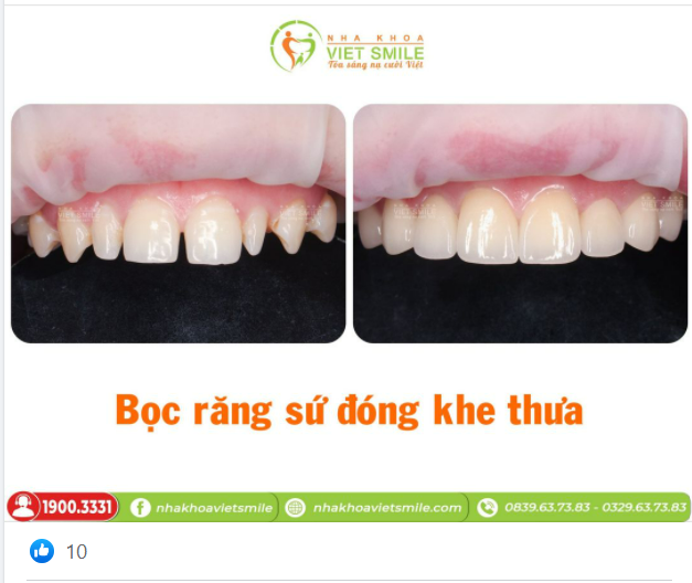 ĐÓNG KHÍT KHE THƯA VỚI BỌC SỨ THẨM MỸ