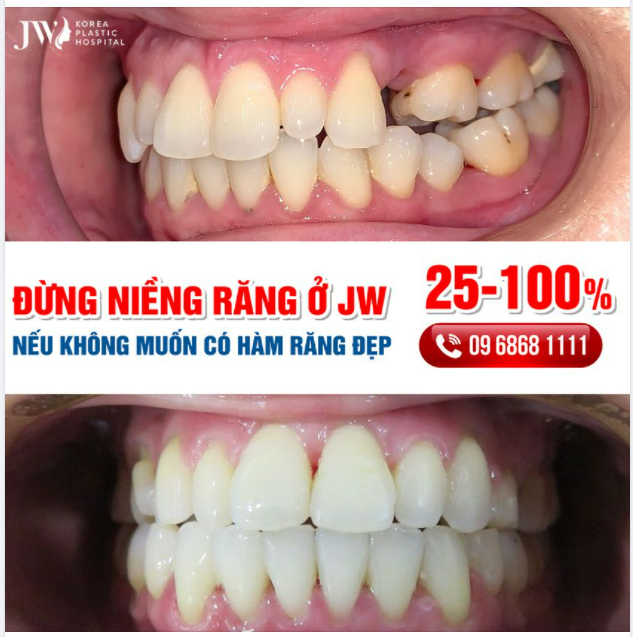 ĐỪNG NIỀNG RĂNG Ở JW – NẾU KHÔNG MUỐN CÓ HÀM RĂNG ĐẸP