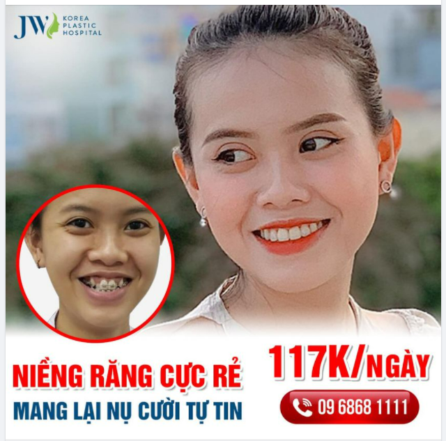 ĐỪNG NIỀNG RĂNG Ở JW – NẾU KHÔNG MUỐN RĂNG ĐỀU THẲNG TẤP