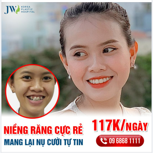 ĐỪNG NIỀNG RĂNG Ở JW – NẾU KHÔNG MUỐN RĂNG ĐỀU THẲNG TẤP