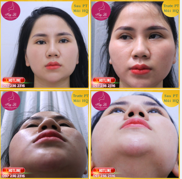 ” Em thấy Nâng mũi Hàn Quốc chỉ có 7 TRIỆU, vậy thì kết quả có đẹp không”