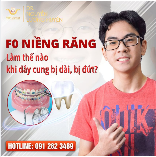 F0 NIỀNG RĂNG Làm thế nào khi dây cung bị dài, bị đứt
