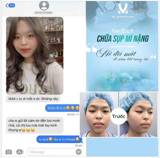 FEEDBACK CHỮA SỤP MI THỂ NẶNG