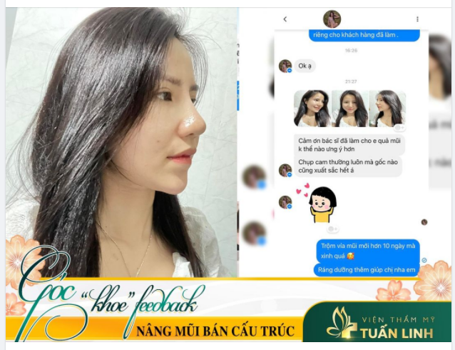 FEEDBACK NÂNG MŨI BÁN CẤU TRÚC