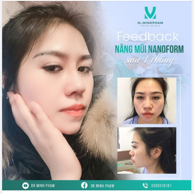 Feedback nâng mũi sau 1 tháng Mũi tây và sang chảnh luôn cả nhà!!