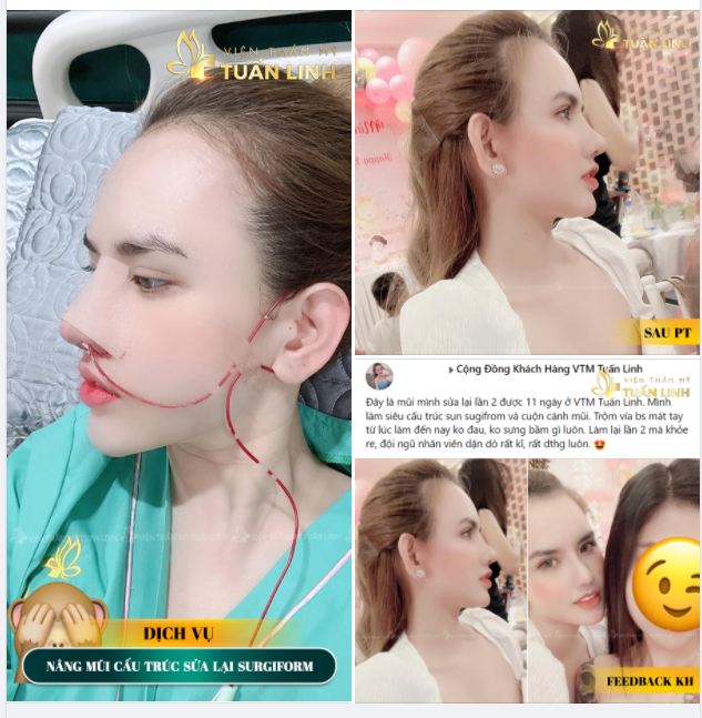 FEEDBACK NÂNG MŨI SỬA LẠI