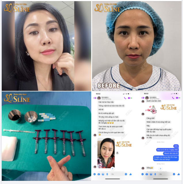 FEEDBACK THỰC TẾ Khách hàng trước và sau khi sử dụng dịch vụ TRẺ HÓA – CĂNG BÓNG DA.