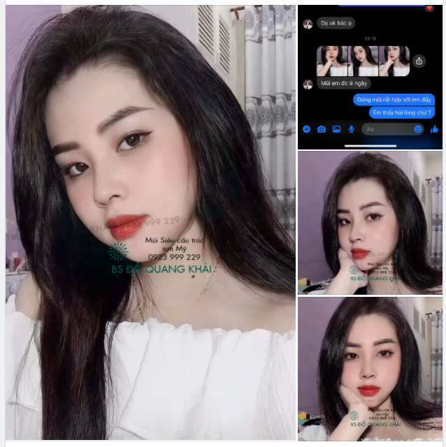 FEEDBACK TỪ KHÁCH HÀNG SAU 9 NGÀY NÂNG MŨI