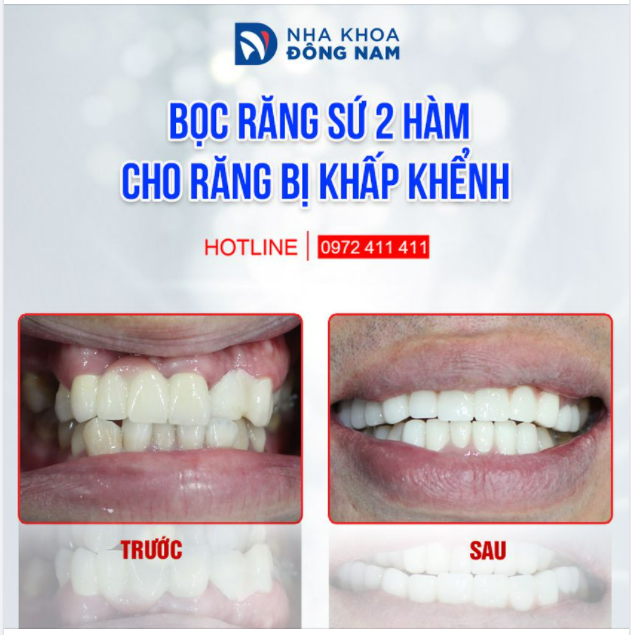 GIẢI CỨU RĂNG SỨ HỎNG