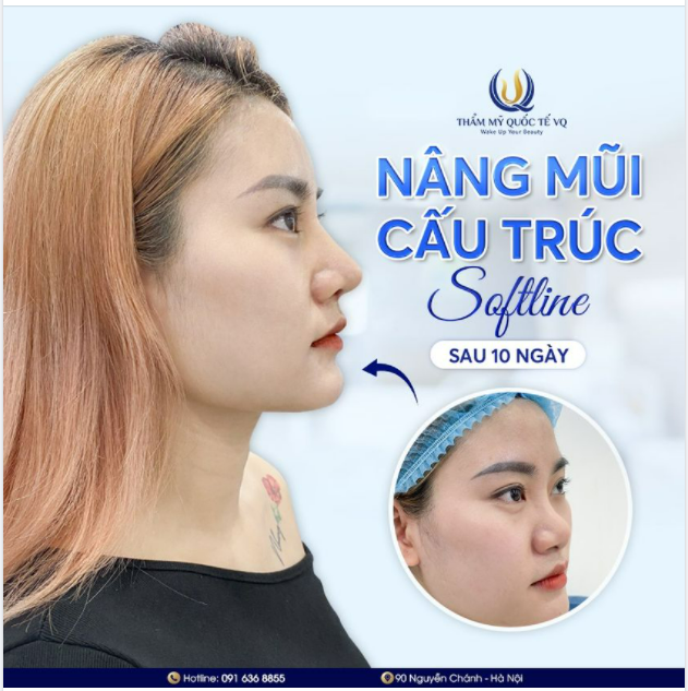 ''Giải mã'' thắc mắc của khách hàng - Nâng mũi 10 ngày đã đẹp chưa