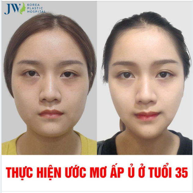 GỌT MẶT VLINE THỰC HIỆN ƯỚC MƠ ẤP Ủ Ở TUỔI 35